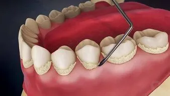 Механическая очистка