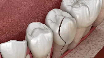Сколы и микротрещины