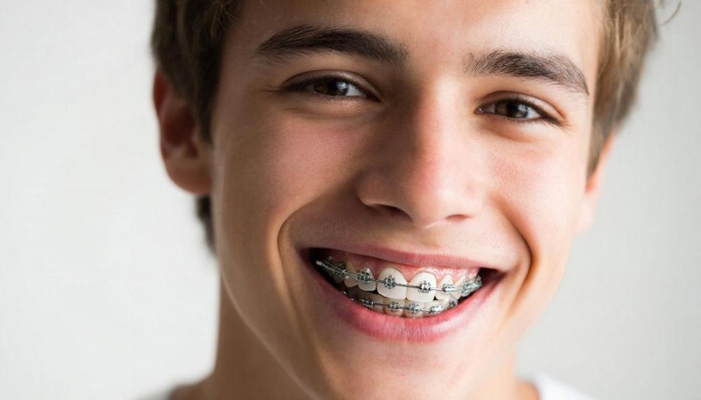 Damon брекеты- современное решение для идеальной улыбки