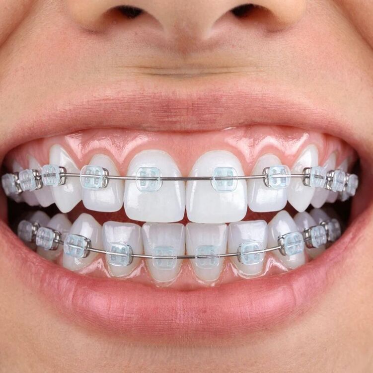 Ортодонтические брекеты что это: фундаментальный инструмент создания идеальной улыбки