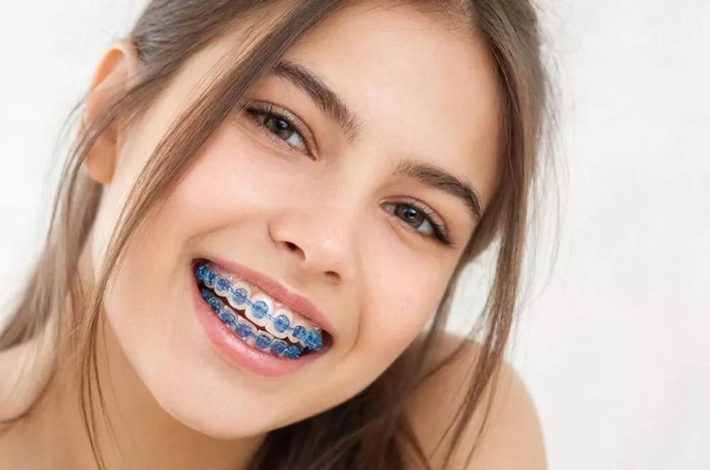 Сапфировые брекеты что это: невидимая эстетика и современная ортодонтия