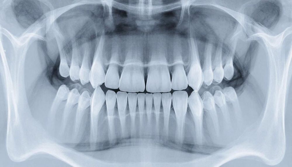 Ортопантомограмма 