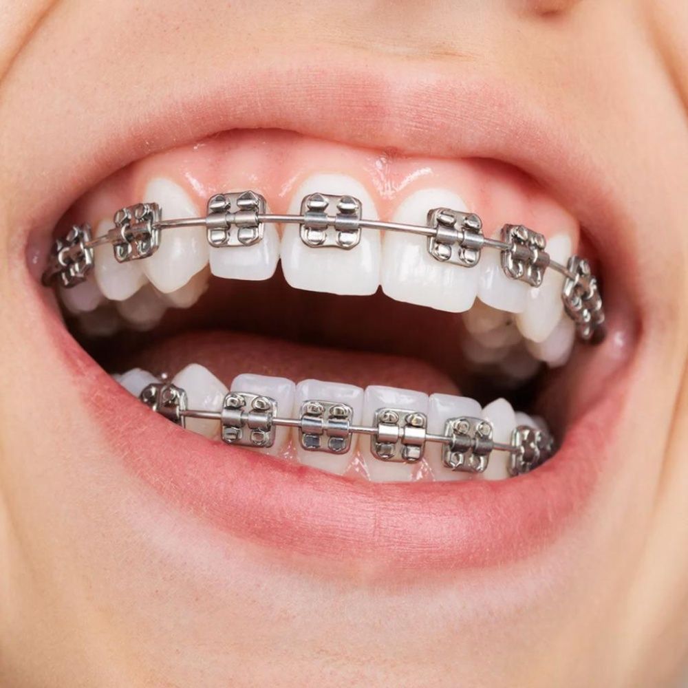 Металлические брекеты что это: проверенная классика ортодонтического лечения