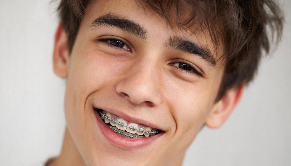 Каппы: современное решение для выравнивания зубов