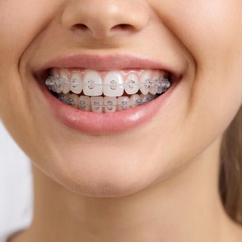 Брекеты невидимые что это: эволюция ортодонтии в сторону эстетики и комфорта