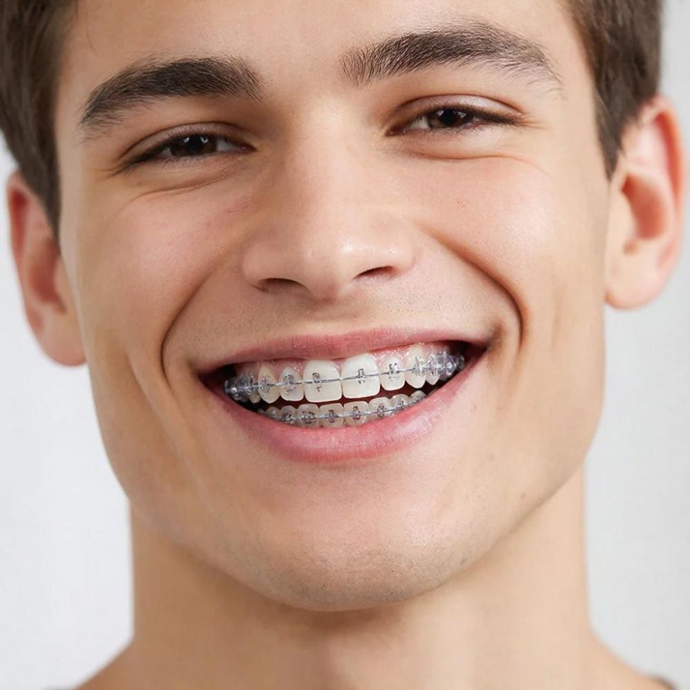 Прозрачные брекеты что это: эстетическая революция в исправлении прикуса