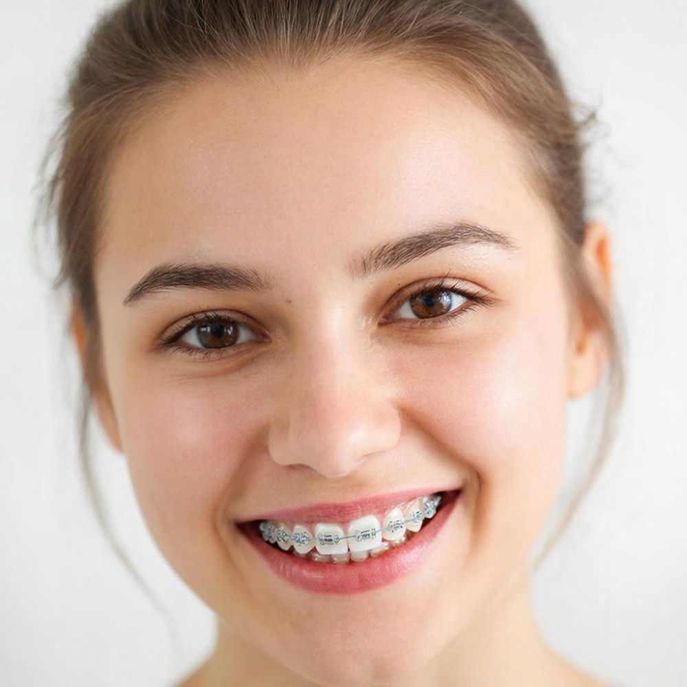 Безлигатурные брекеты что это: эволюция в ортодонтии, где эффективность встречается с комфортом