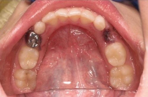 Лечение кариеса молочных зубов, покрытие коронкой  - фото после
