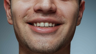 Выпрямление кривых зубов