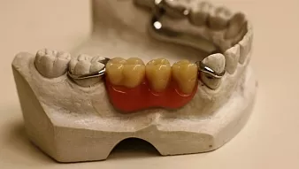 Мостовидные протезы на 3 зуба