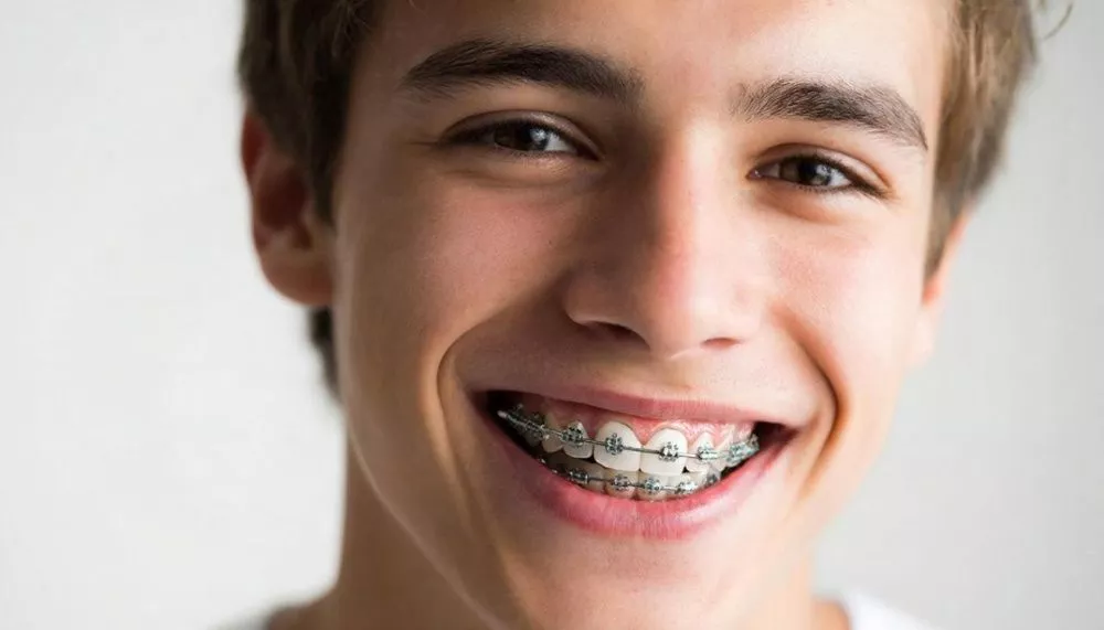 Damon брекеты- современное решение для идеальной улыбки