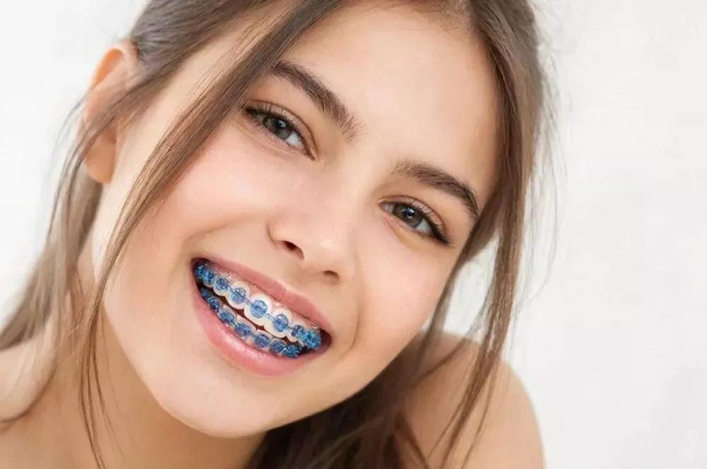 Сапфировые брекеты что это: невидимая эстетика и современная ортодонтия