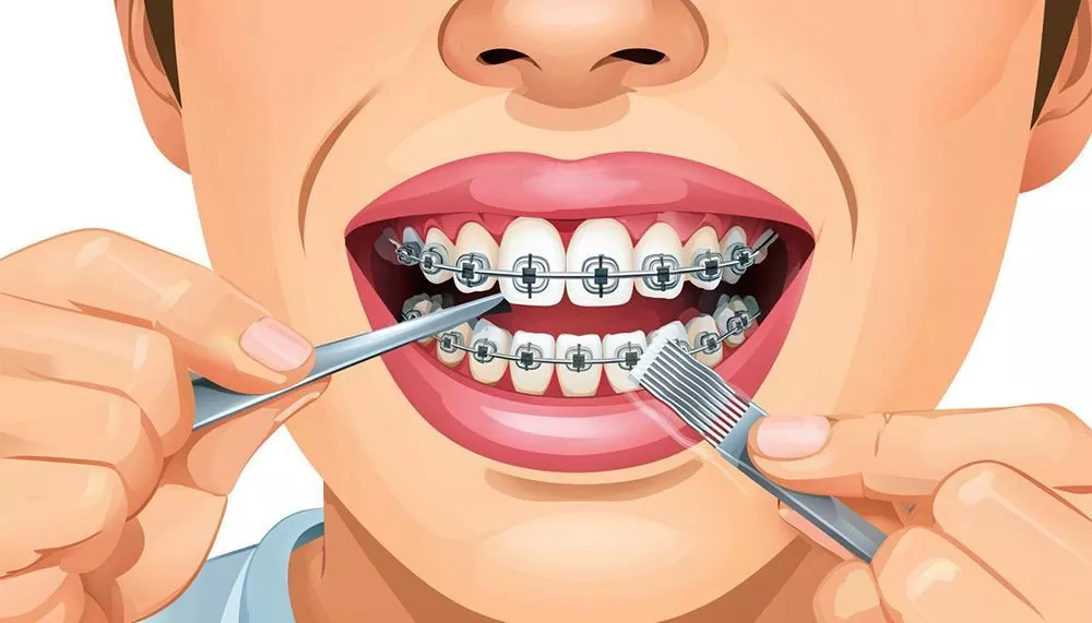 Чистка зубов с брекетами: полное руководство по уходу