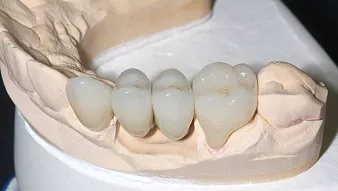Мостовидные протезы на 4 зуба