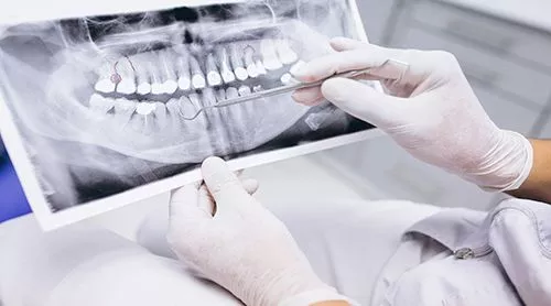 Рентген-диагностика полости рта